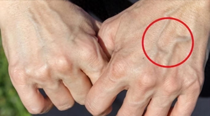 手臂“青筋暴起”的人，和几乎看不到青筋的人相比，哪种更健康？