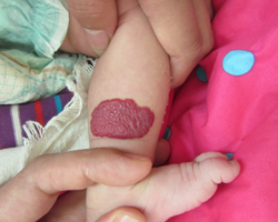 婴儿血管瘤会消退吗？宝妈一看就懂，3秒收藏